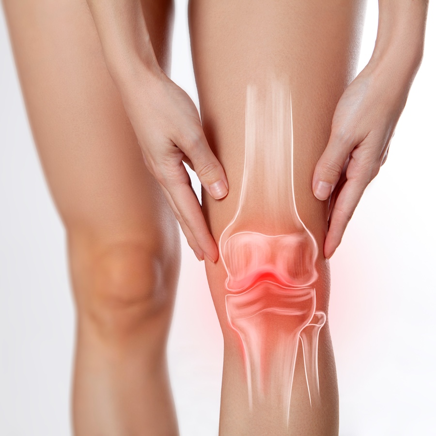 Osteoartrosi, cos'è e come si previene con la viscoinduzione e viscosupplementazione
